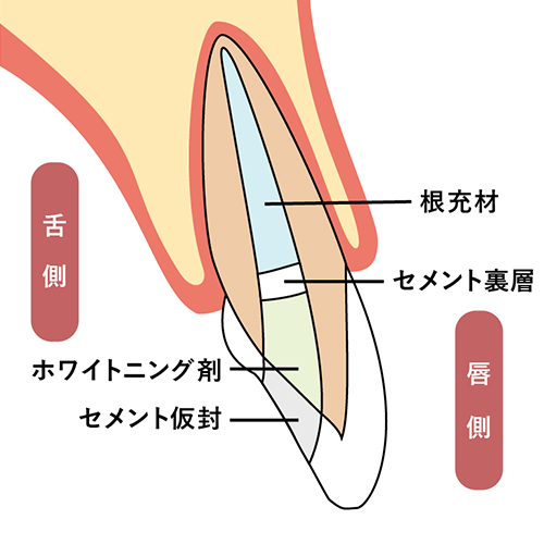 ホームホワイトニング