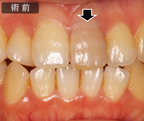 治療例（治療期間：4週間程度※１週間に１度薬剤交換）