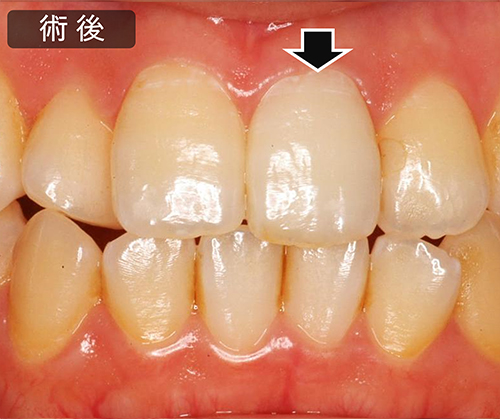 治療例（治療期間：4週間程度※１週間に１度薬剤交換）