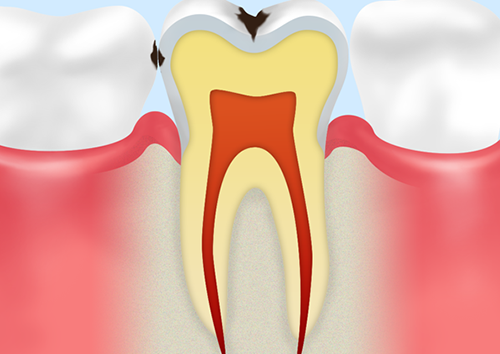 C1：エナメル質のむし歯