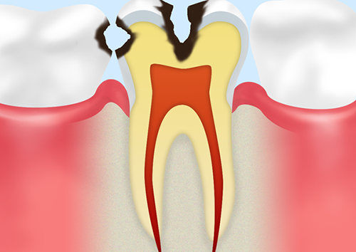 C2：象牙質のむし歯