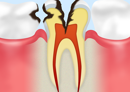 C3：神経に達したむし歯