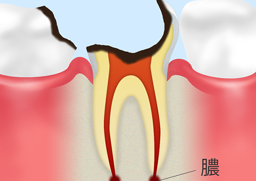 C4：歯根に達したむし歯