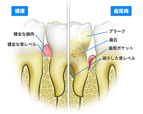 歯周病医の優位性