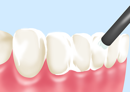 う蝕リスクの高い方にはフッ化物塗布と洗口