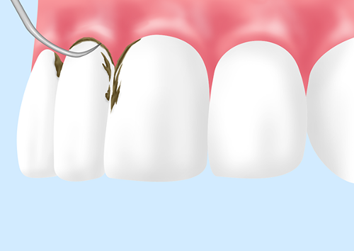 スケーリングで歯石を除去