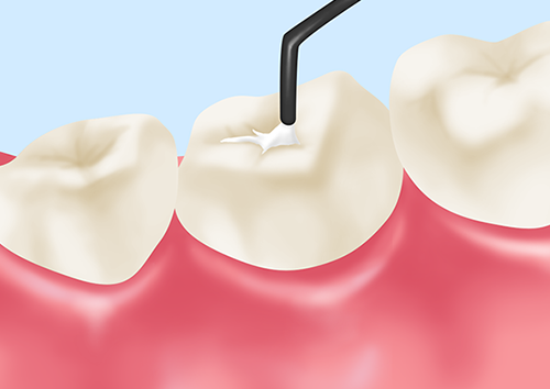 生えたばかりの歯にはシーラントを