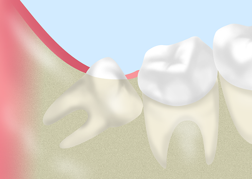 親知らずの抜歯について