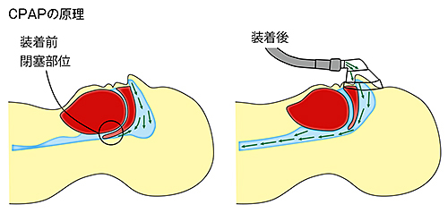 治療方法について（CPAP）